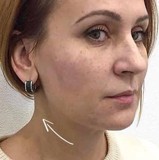 Обличчя жінки після лікування