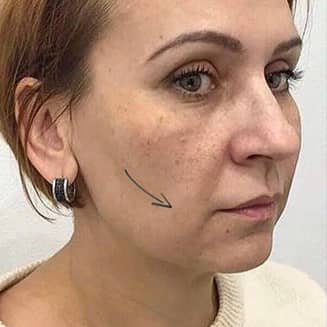Обличчя жінки до лікування